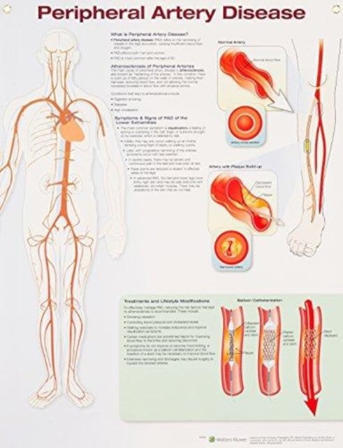 Cover for Anatomical Chart Company · Peripheral Artery Disease (Poster) (2018)