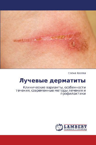 Cover for Elena Khoseva · Luchevye Dermatity: Klinicheskie Varianty, Osobennosti Techeniya, Sovremennye Metody Lecheniya I Profilaktiki (Paperback Book) [Russian edition] (2012)