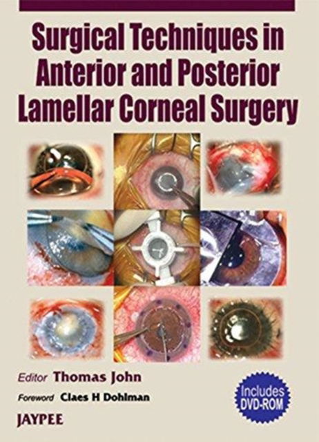 Surgical Techniques in Anterior and Posterior Lamellar Corneal Surgery - John Thomas - Books - Jaypee Brothers Medical Publishers - 9788180616051 - January 22, 2006