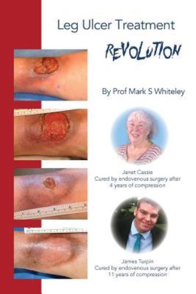 Cover for Mark Whiteley · Leg Ulcer Treatment Revolution (Paperback Book) (2018)