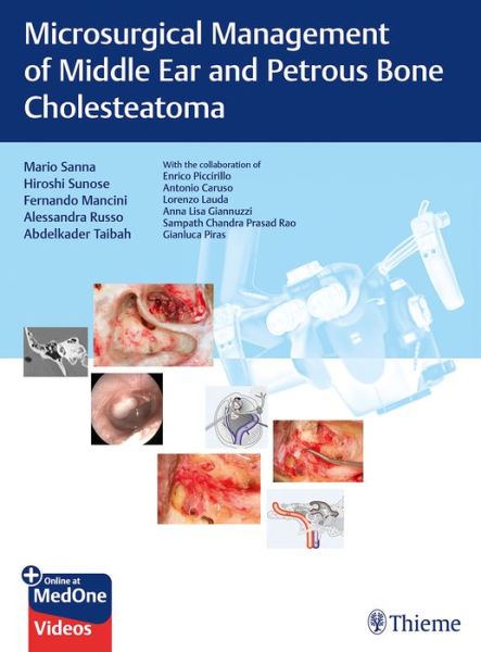 Cover for Mario Sanna · Microsurgical Management of Middle Ear and Petrous Bone Cholesteatoma (Book) (2019)