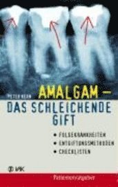 Cover for Peter Kern · Amalgam - Das Schleichende Gift (Book)