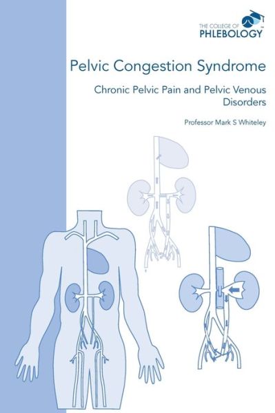 Cover for Mark S Whiteley · Pelvic Congestion Syndrome - Chronic Pelvic Pain and Pelvic Venous Disorders (Paperback Book) (2019)