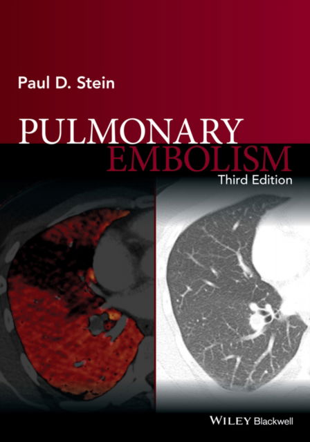Cover for Stein, Paul D. (College of Osteopathic Medicine, Michigan State University, East Lansing, Michigan, USA) · Pulmonary Embolism (Hardcover Book) (2016)