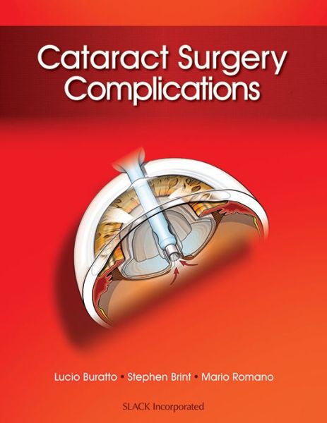 Cover for Lucio Buratto · Cataract Surgery Complications (Hardcover Book) (2012)