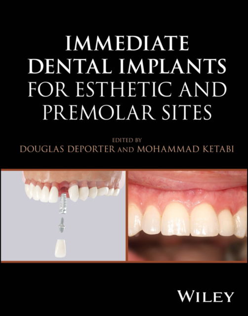 Cover for Deporter, Douglas (University of Toronto, ON, Canada) · Immediate Dental Implants for Esthetic and Premolar Sites (Innbunden bok) (2025)