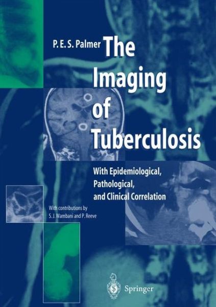 Cover for P.E.S. Palmer · The Imaging of Tuberculosis: With Epidemiological, Pathological, and Clinical Correlation (Paperback Book) [Softcover reprint of the original 1st ed. 2002 edition] (2012)