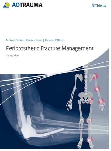 Cover for Michael Schutz · Periprosthetic Fracture Management (Inbunden Bok) (2013)