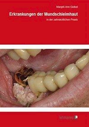 Cover for Geibel · Erkrankungen der Mundschleimhaut (Bok)