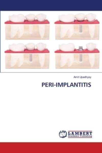 Cover for Upadhyay · Peri-implantitis (Book) (2020)