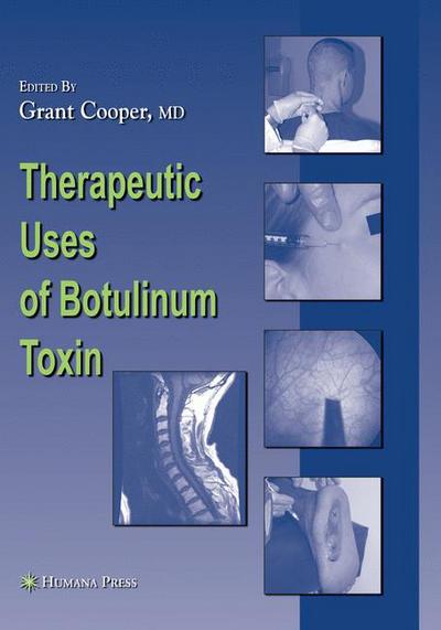 Cover for Grant C Cooper · Therapeutic Uses of Botulinum Toxin - Musculoskeletal Medicine (Hardcover Book) [2007 edition] (2007)