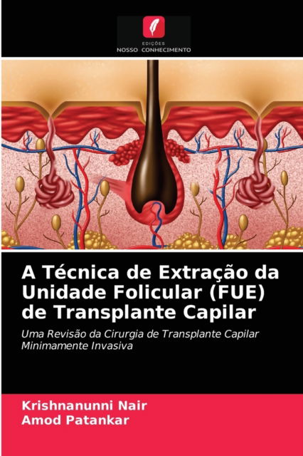 A Tecnica de Extracao da Unidade Folicular (FUE) de Transplante Capilar - Krishnanunni Nair - Books - Edicoes Nosso Conhecimento - 9786203536157 - March 26, 2021