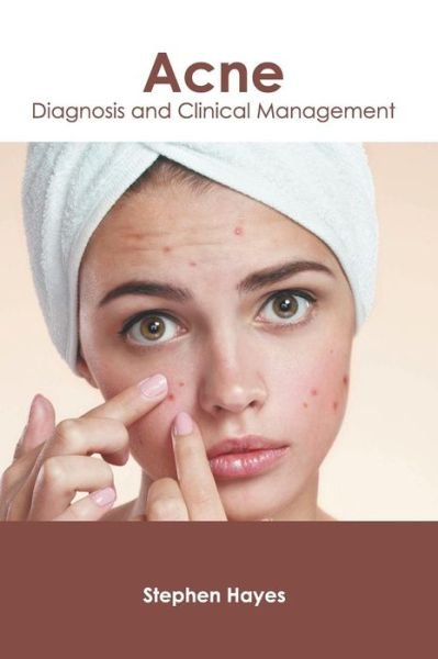 Cover for Stephen Hayes · Acne: Diagnosis and Clinical Management (Hardcover Book) (2019)