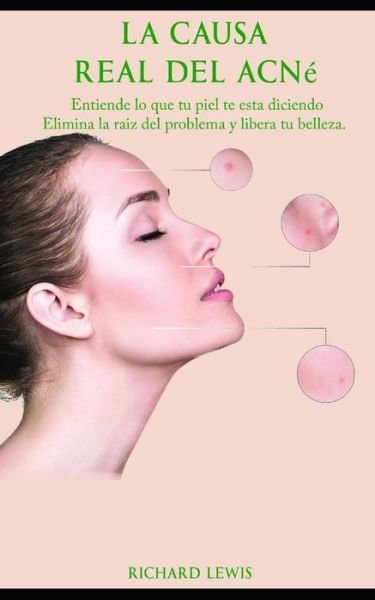 La Causa Real Del Acne - Richard Lewis - Böcker - Independently Published - 9798672566184 - 10 augusti 2020