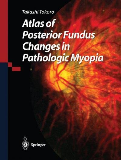 Cover for Takashi Tokoro · Atlas of Posterior Fundus Changes in Pathologic Myopia (Paperback Book) [Softcover reprint of the original 1st ed. 1998 edition] (2011)