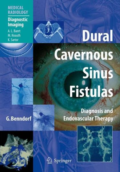 Cover for Goetz Benndorf · Dural Cavernous Sinus Fistulas: Diagnosis and Endovascular Therapy - Medical Radiology (Hardcover Book) (2009)