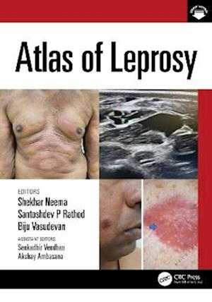 Cover for Atlas of Leprosy (Paperback Book) (2025)