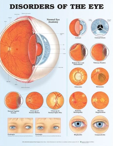 Cover for Acc · Disorders of the Eye Anatomical Chart (Landkarten) (2006)