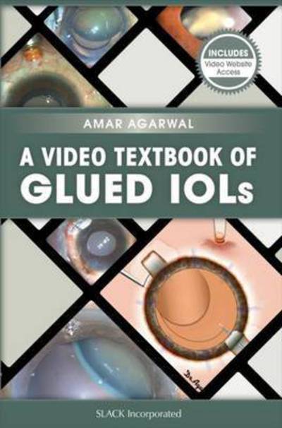 Cover for Amar Agarwal · A Video Textbook of Glued IOLs (Paperback Book) (2016)