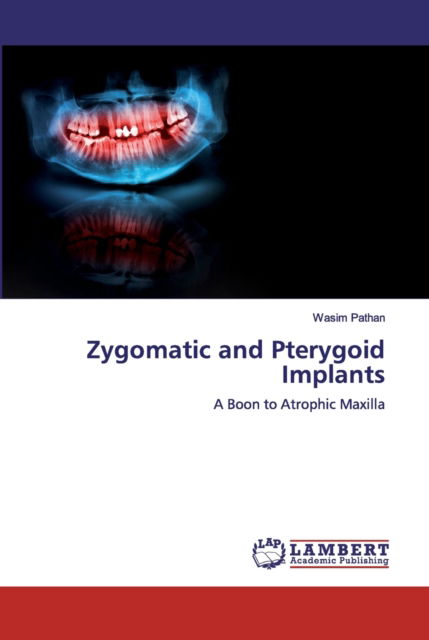 Cover for Wasim Pathan · Zygomatic and Pterygoid Implants (Paperback Book) (2019)