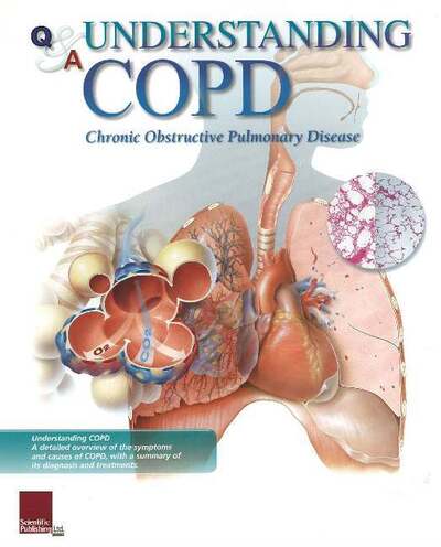 Cover for Scientific Publishing · Understanding COPD Flip Chart (Spiralbok) (2006)