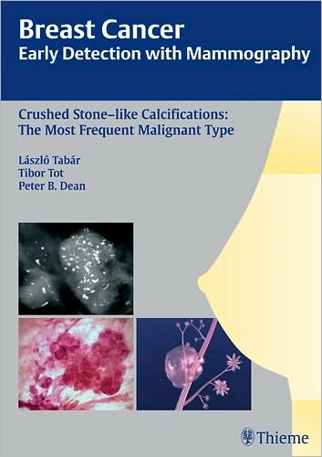 Breast Cancer: Early Detection with Mammography: Crushed Stone-like Calcifications: The Most Frequent Malignant Type - Tabar Mammo - Laszlo Tabar - Bücher - Thieme Publishing Group - 9783131485311 - 12. März 2008