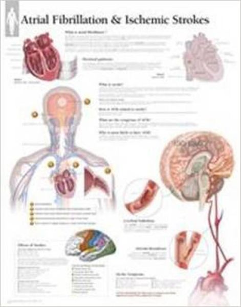 Cover for Scientific Publishing · Atrial Fib &amp; Ischemic Strokes Paper Poster (Kartor) (2013)