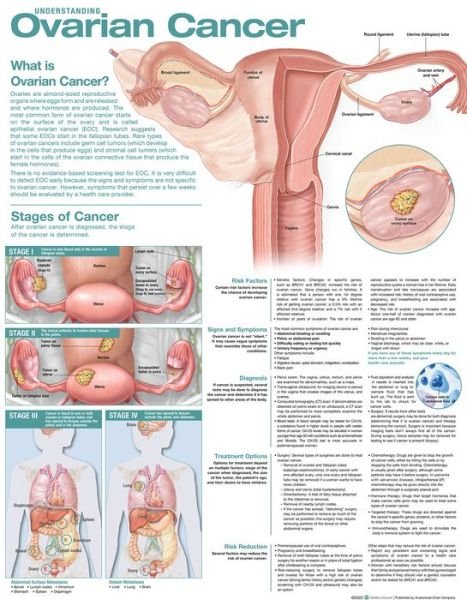 Cover for Anatomical Chart Com · Understanding Ovarian Cancer Anatomical Chart (Map) (2022)