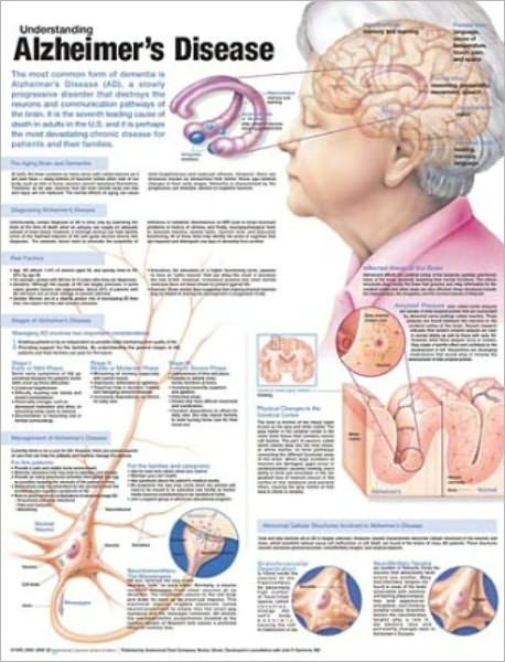 Cover for Anatomical Chart Com · Understanding Alzheimer's Disease Anatomical Chart (Landkarten) (2009)