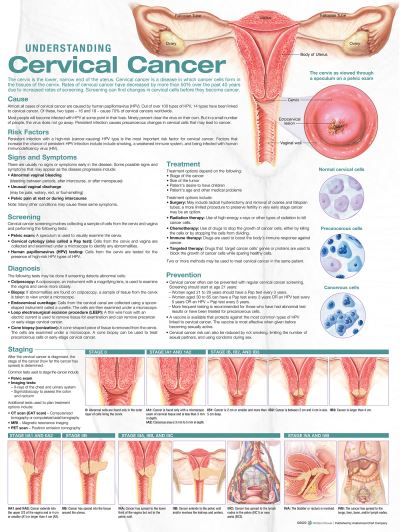 Cover for Anatomical Chart Com · Understanding Cervical Cancer Anatomical Chart (Map) (2022)