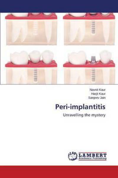 Cover for Jain Sanjeev · Peri-implantitis (Paperback Book) (2015)