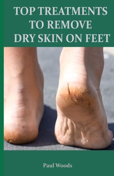 Top Treatments to Remove Dry Skin on Feet - Paul Woods - Books - Independently Published - 9798676786342 - August 21, 2020