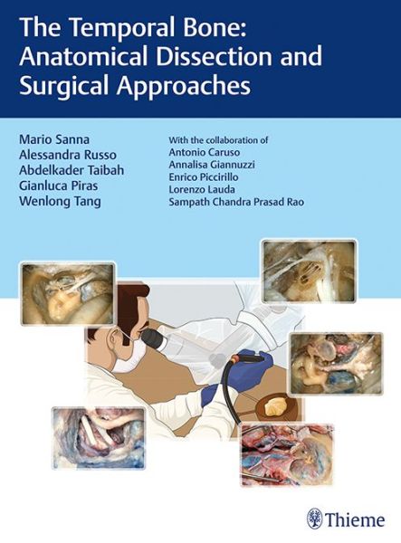 Mario Sanna · The Temporal Bone: Anatomical Dissection and Surgical Approaches (Hardcover bog) (2018)