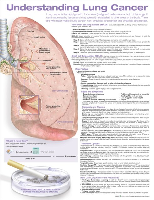 Cover for Acc · Understanding Lung Cancer Anatomical Chart (Kartor) (2022)