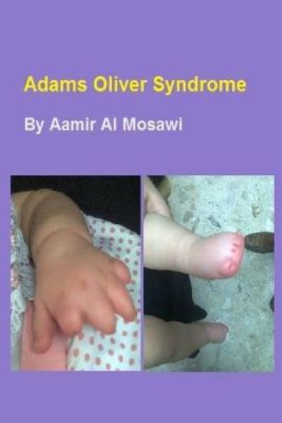 Cover for Aamir Jalal Al Mosawi · Adams Oliver Syndrome (Paperback Book) (2018)