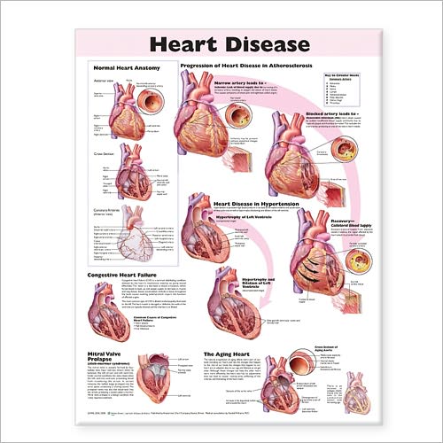 Heart Disease Anatomical Chart - Acc - Books - Lippincott Williams and Wilkins - 9780781773379 - January 25, 2008