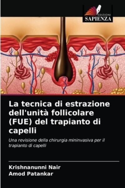 La tecnica di estrazione dell'unita follicolare (FUE) del trapianto di capelli - Krishnanunni Nair - Books - Edizioni Sapienza - 9786203536386 - March 26, 2021