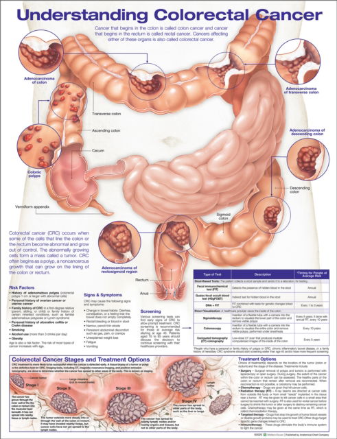 Cover for Acc · Understanding Colorectal  Cancer Anatomical Chart (Landkarten) (2022)