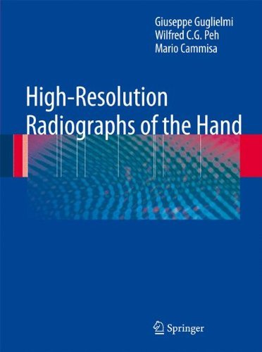 Giuseppe Guglielmi · High-Resolution Radiographs of the Hand (Paperback Bog) [Softcover reprint of hardcover 1st ed. 2009 edition] (2010)