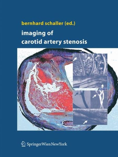 Cover for Bernhard Schaller · Imaging of Carotid Artery Stenosis (Paperback Book) [2007 edition] (2014)