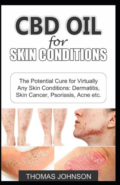 CBD Oil for Skin Conditions - Thomas Johnson - Kirjat - Independently Published - 9781091374423 - lauantai 23. maaliskuuta 2019