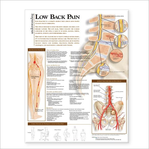 Cover for Acc · Understanding Low Back Pain Anatomical Chart (Landkarten) (2008)