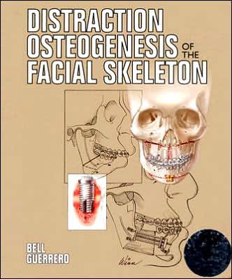 Cover for William Bell · Distraction Osteogenesis of the Facial Skeleton (Hardcover Book) (2007)
