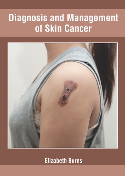 Cover for Elizabeth Burns · Diagnosis and Management of Skin Cancer (Hardcover Book) (2019)