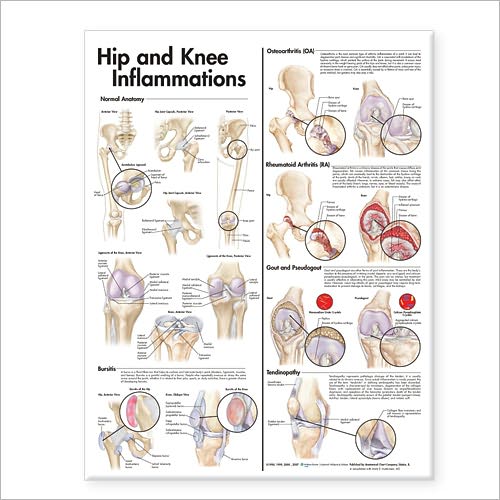 Cover for Anatomical Chart Com · Hip and Knee Inflammations Anatomical Chart (Map) (2007)