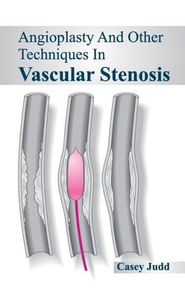 Cover for Casey Judd · Angioplasty and Other Techniques in Vascular Stenosis (Hardcover Book) (2015)
