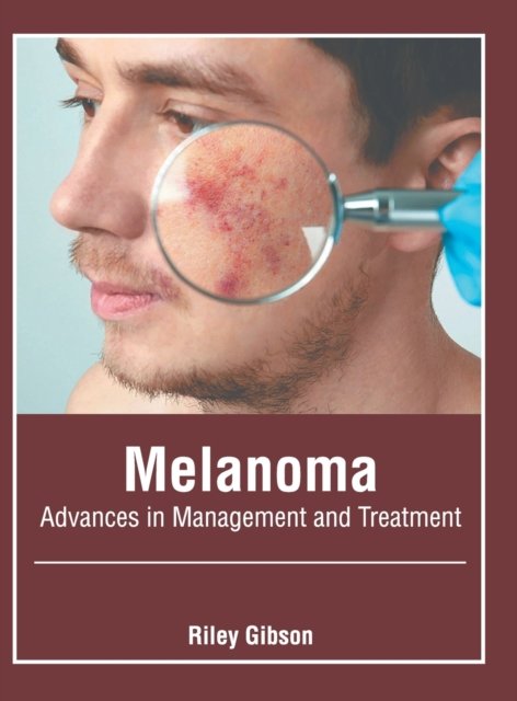 Cover for Riley Gibson · Melanoma: Advances in Management and Treatment (Gebundenes Buch) (2020)