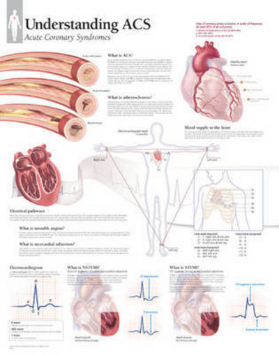 Cover for Scientific Publishing · Understanding ACS (Acute Coronary Syndrome) Laminated Poster (Poster) (2015)