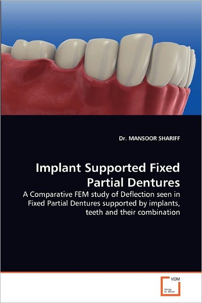 Implant Supported Fixed Partial Dentures: a Comparative Fem Study of Deflection Seen in Fixed Partial Dentures Supported by Implants, Teeth and Their Combination - Dr. Mansoor Shariff - Livros - VDM Verlag Dr. Müller - 9783639356496 - 13 de maio de 2011