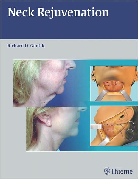 Neck Rejuvenation - Gentile Richard D. - Livres - Thieme Medical Publishers Inc - 9781604060560 - 14 janvier 2011
